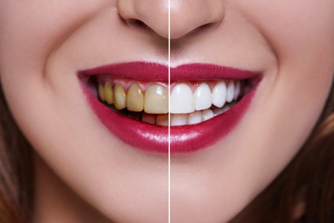 A Comprehensive Guide to Dental Whitening